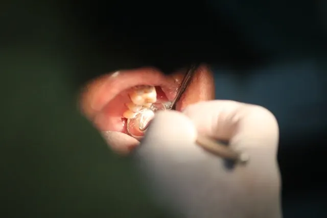 What Does a Cavity Look Like?